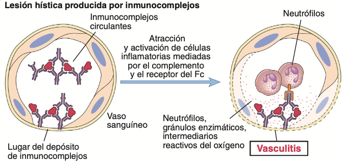 Los anticuerpos pueden depositarse como inmunocomplejos formados en la circulación