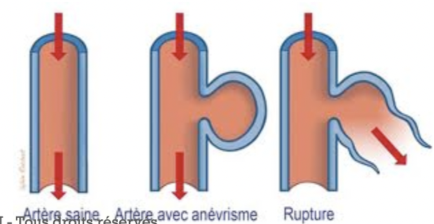 Facteur de risque et traitement:
L’hypertension est souvent la pathologie qui déclenche la rupture d’anévrisme et donc la dis