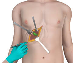 Open cholecystectomy is the classic surgical treatment for gallstones which requires an abdominal incision. The patient is to