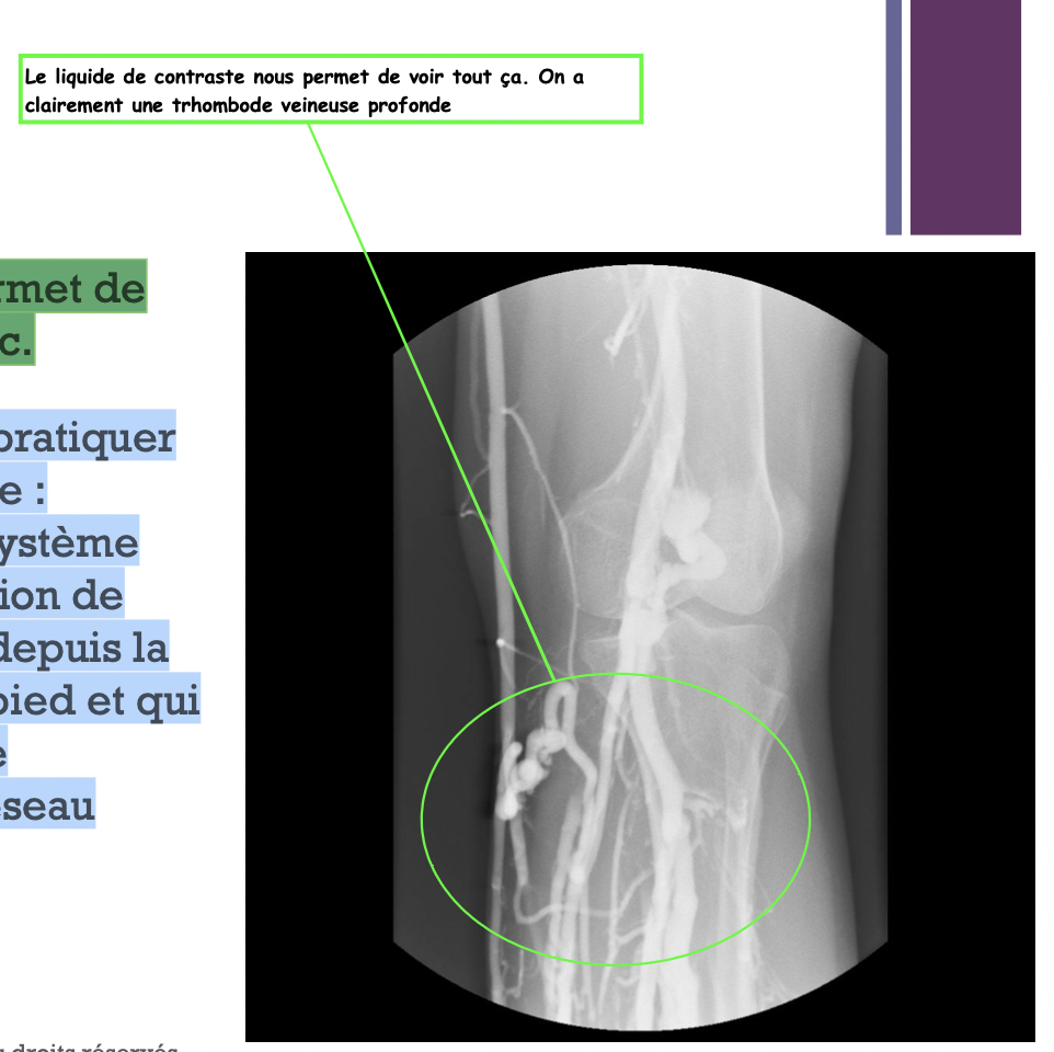 Diagnostic:
L’échographie permet de poser le diagnostic.
Il est possible de pratiquer une phlébographie : radiographie du sys