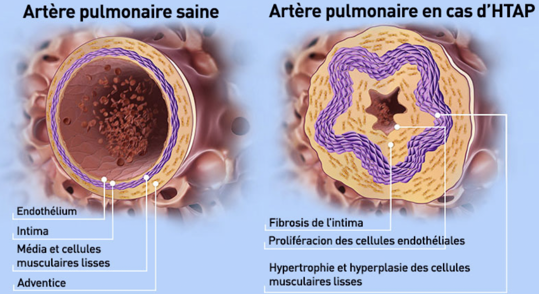 Quelles sont les formes d’hypertension pulmonaire ?
L’hypertension pulmonaire peut avoir diverses causes, raison pour laquell