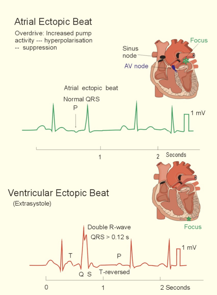 Les extrasystoles: (Très fréquents)
Elles occasionnent des palpitations, véritables sensations d’arrêt du cœur, voir des sens