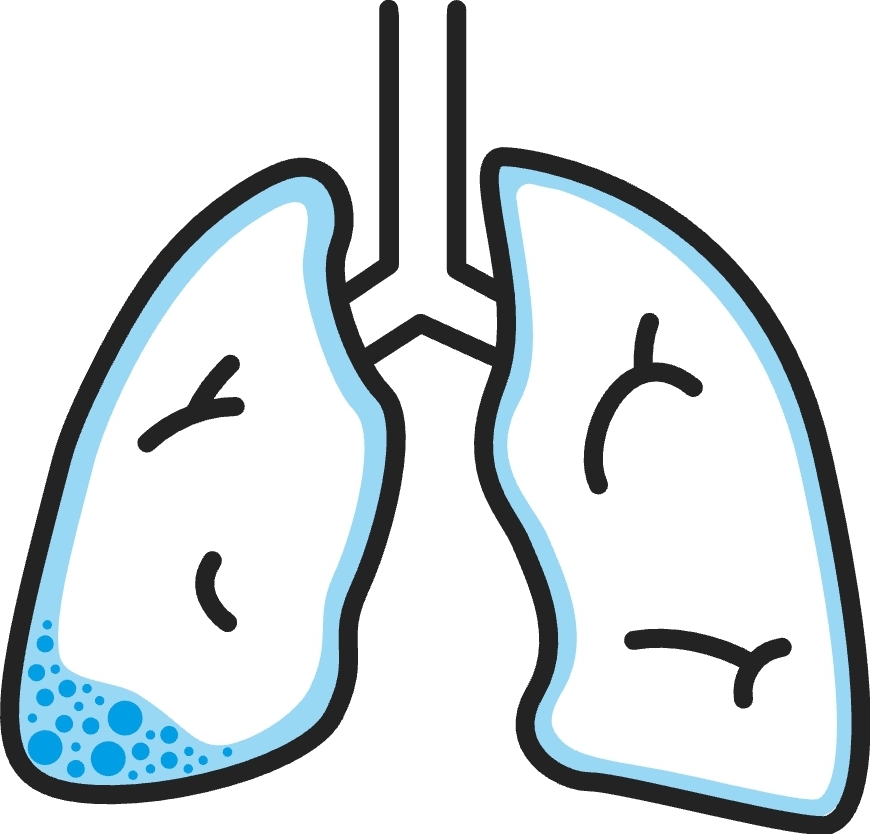 Derrame pleural