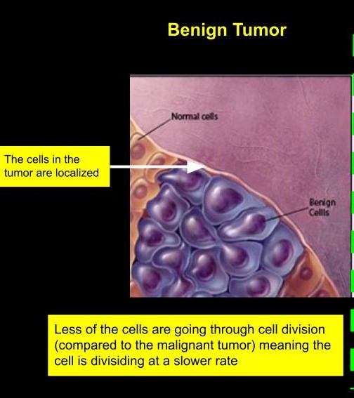 Benign Tumor
A benign tumor describes tumors which are localized to a specific place, and are not  disruptive (not as much as