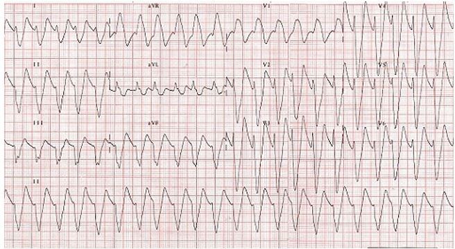 Descripción completa del electrocardiograma