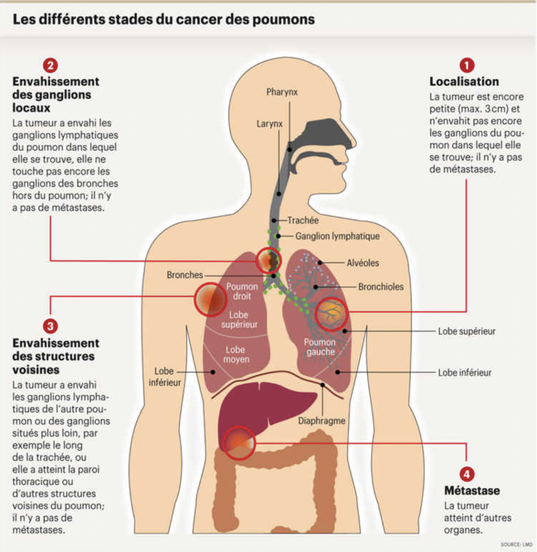 Image: différents stades du cancer du poumon