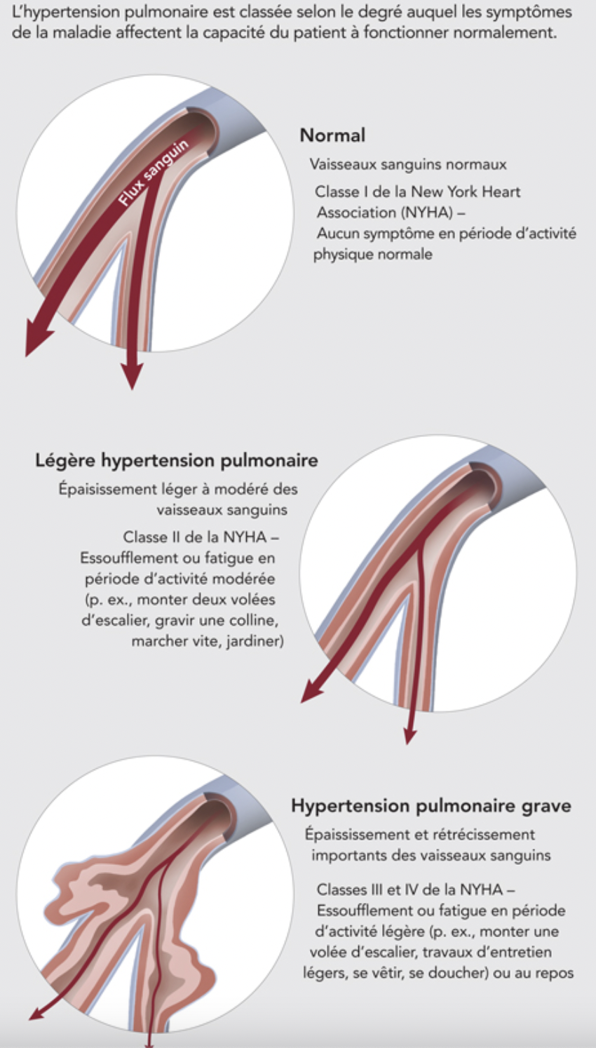 Progression de l'hypertension pulmonaire dans les artères des poumons