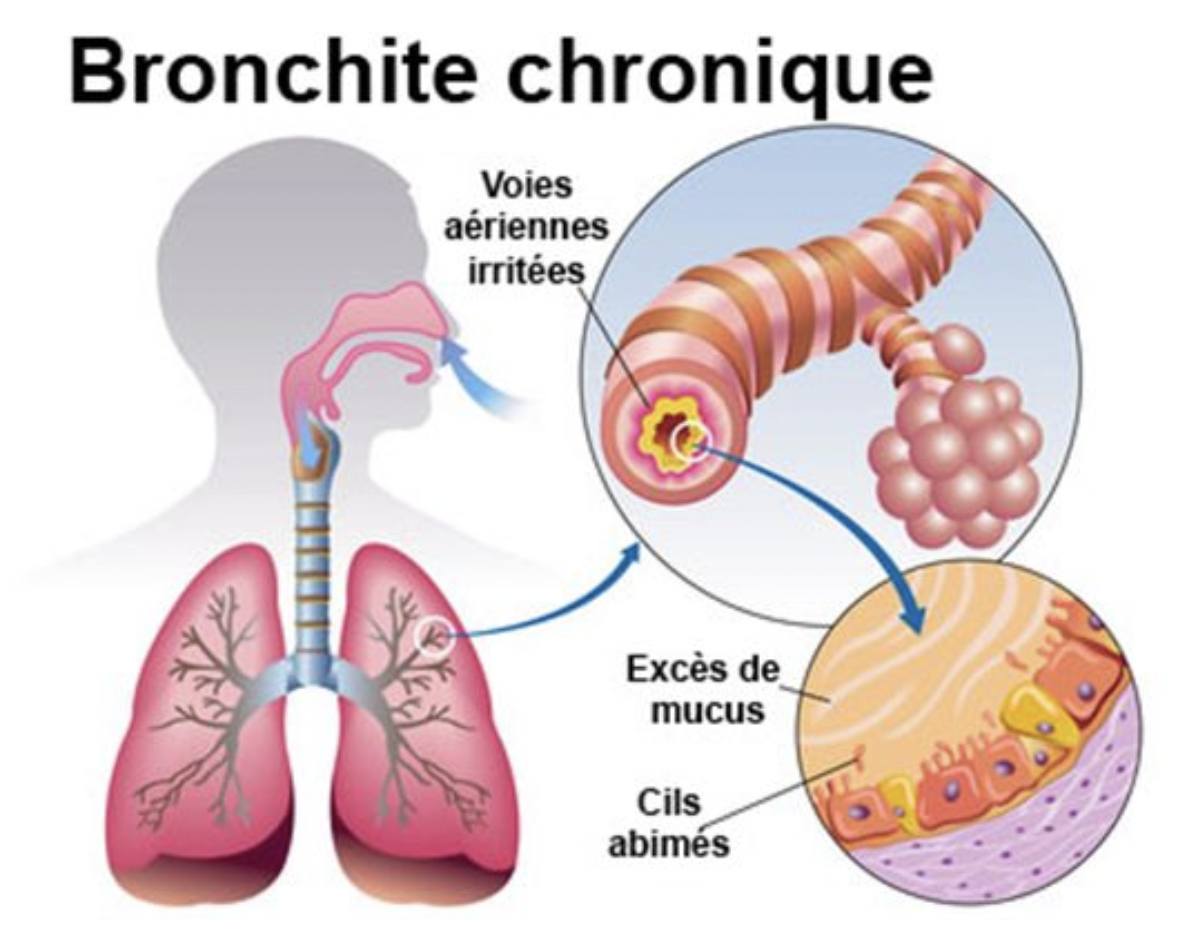 La bronchite chronique est une inflammation des bronches fréquemment accompagnée d’asthme : elle se caractérise par une obstr