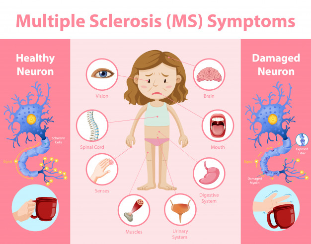 Esclerosis múltiple (EM)