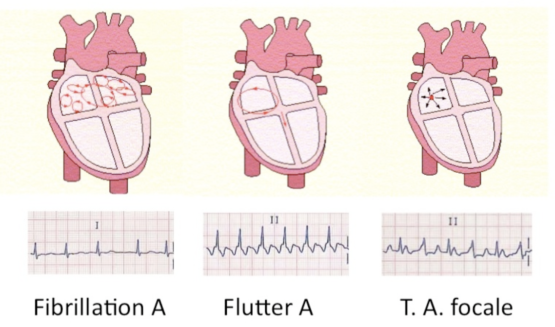 La fibrillation auriculaire:
Trouble le plus fréquent. L’activité rythmique des oreillettes n’est plus rythmée et subit des t