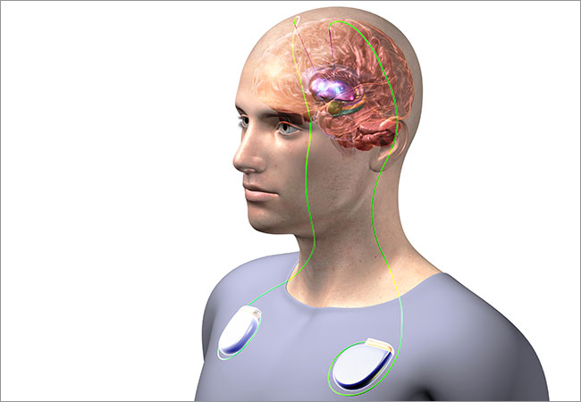 Deep brain stimulation (DBS)
is a surgically implanted device in the chest that will send electrodes to the part of the brain