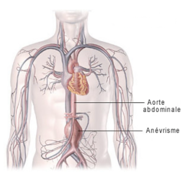 Anévrisme de l’aorte abdominale
C’est une dilatation de l’aorte abdominale avec perte de parallélisme des parois.
Il survient