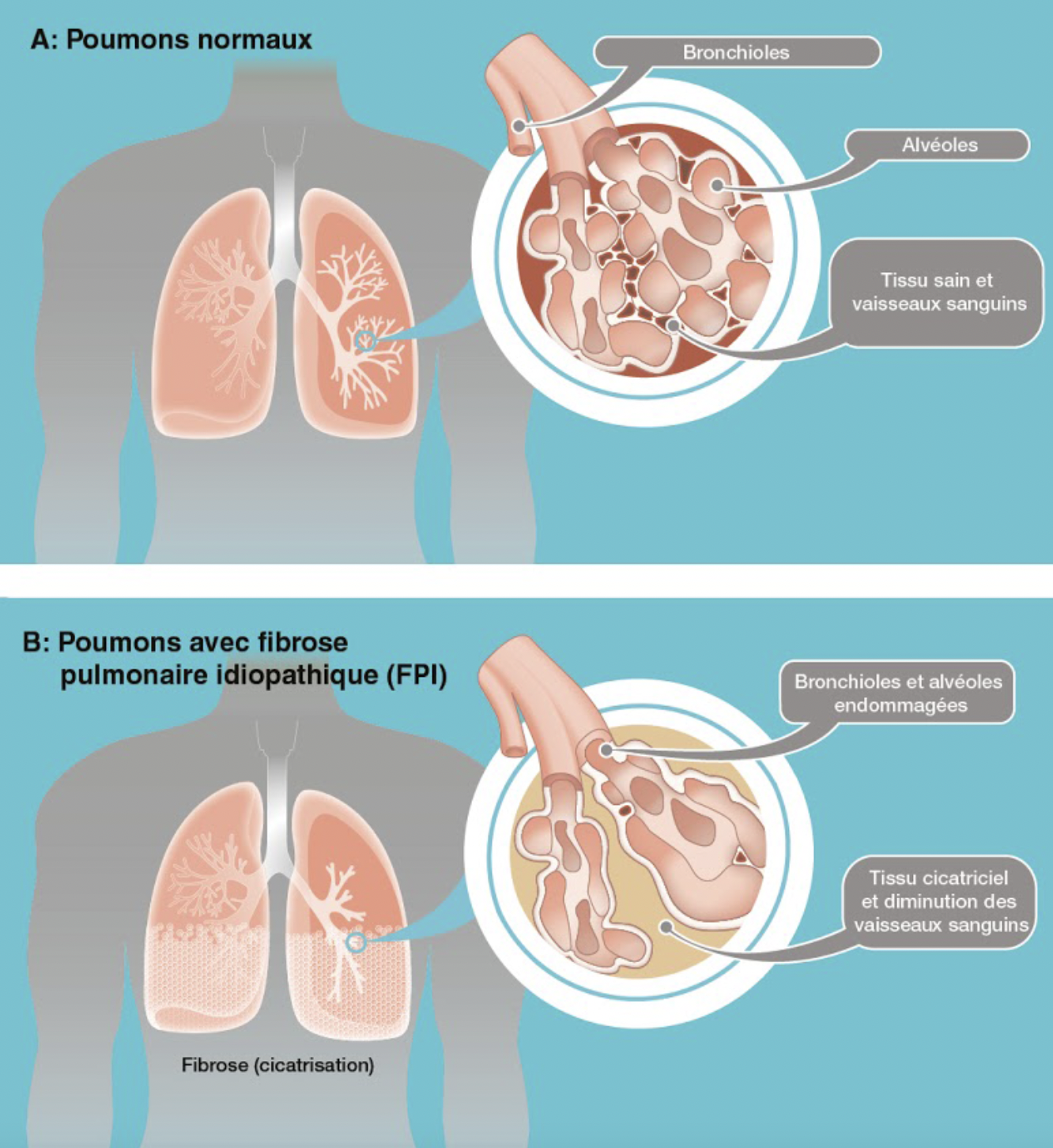 Fibrose pulmonaire idiopathique:
La fibrose pulmonaire est une maladie rare, agressive et évoluant souvent rapidement ; elle 