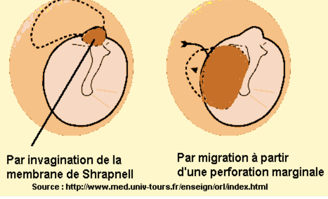 L’otite chronique cholestéatomateuse ou choléstéatome
Physiopathologie :
- Otite inflammatoire avec pénétration de l’épiderme