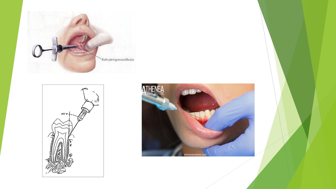 Anestesia Infiltrativa e Interpapilar
Anestesia Troncular
Anestesia Intraligamentosa