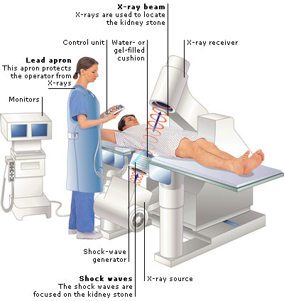 Extracorporeal shock wave lithotripsy. Extracorporeal shock wave lithotripsy (ESWL) is a nonsurgical method for treating gall