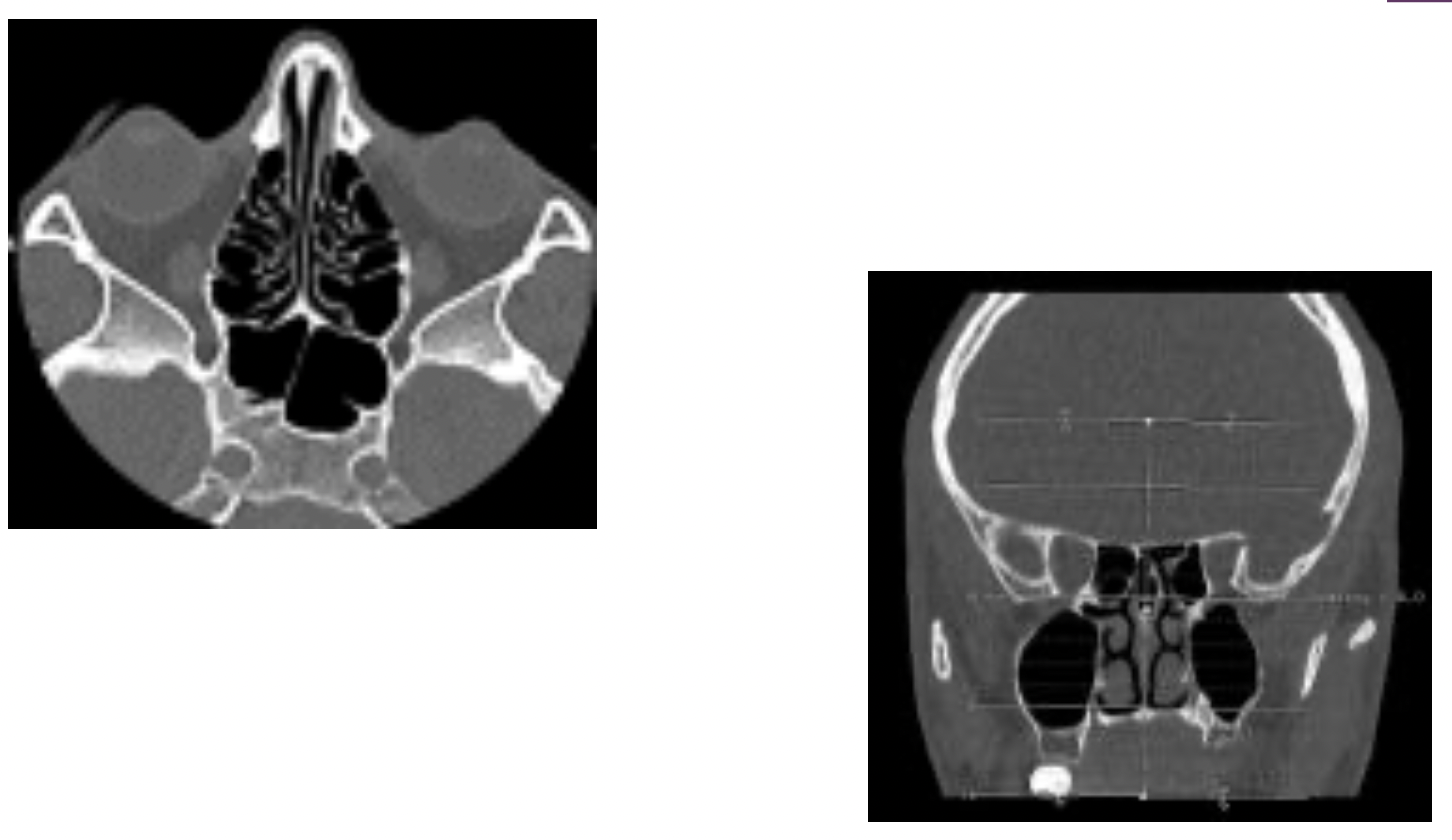 Scanner de la face des sinus