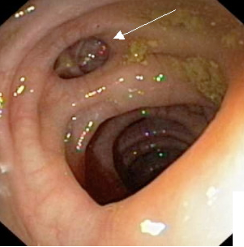 Diverticulites ou sigmoïdites: 
L’inflammation des diverticules du côlon est une
affection qui touche plus de 10% de la popul