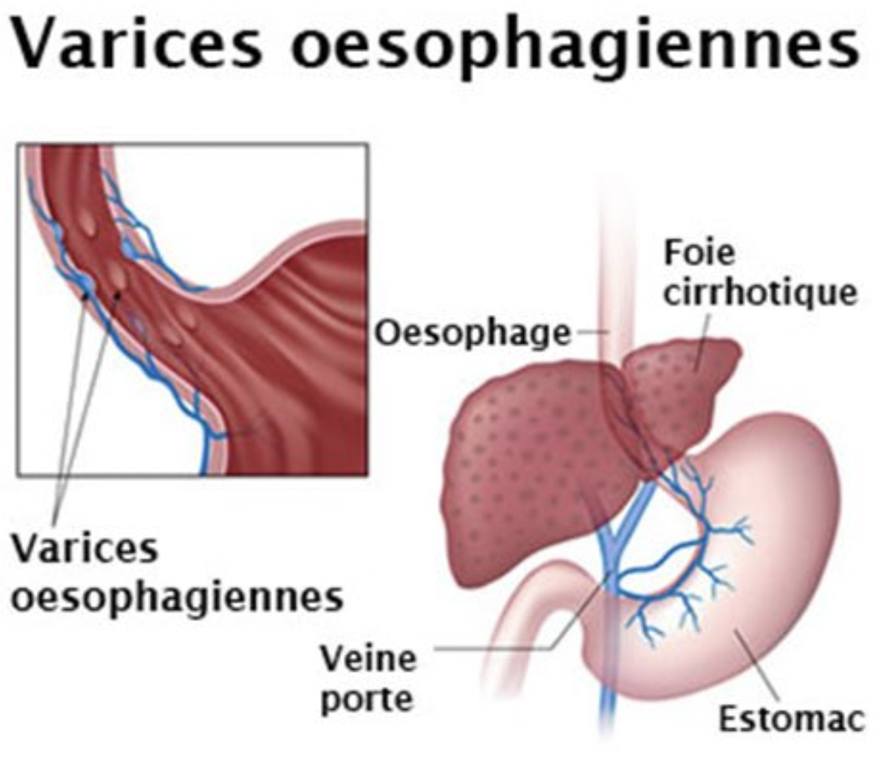 Varices oesophagiennes:
Les veines de l'oesophage évacuent le sang vers le foie. Si au niveau hépatique la circulation devien