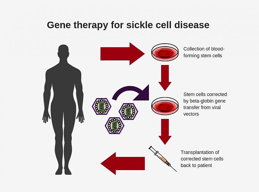 Gene Therapy