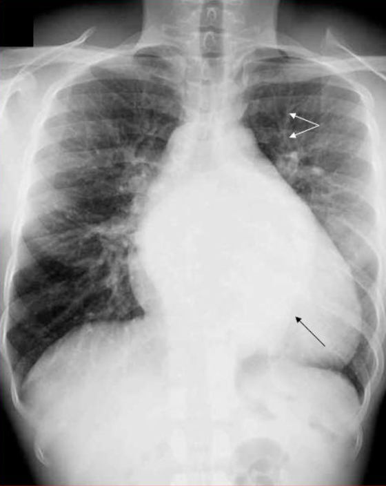 Radiographie du thorax