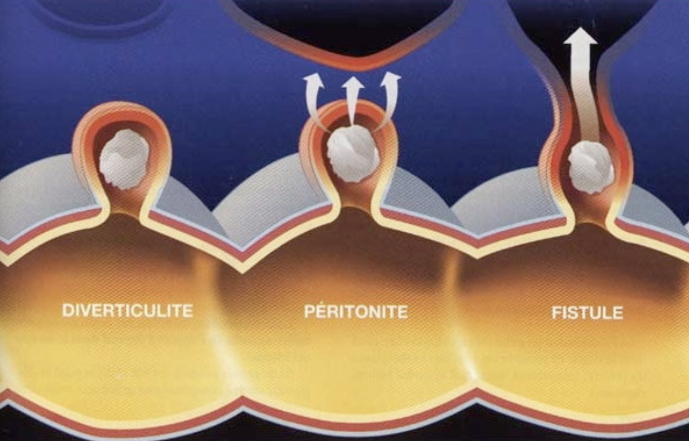 De la diverticulose à la diverticulite
La diverticulite aigue se manifeste par un tableau d’appendicite gauche: douleur de la