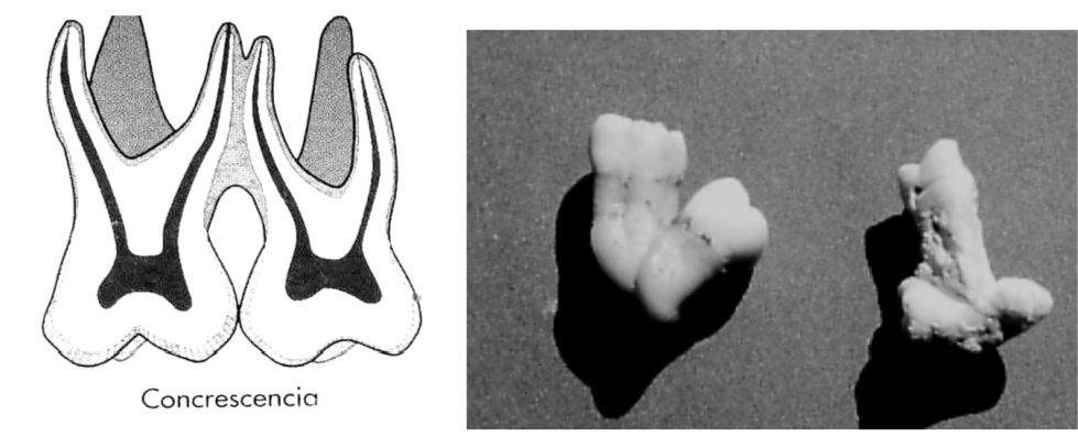 Concrescencia: Forma de fusión en que los dientes están unidos por el cemento, normalmente ocurre cerca al tercio apical y es