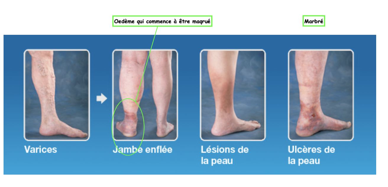 Signes cliniques et traitement:
Localement, outre la dilatation veineuse, peut être mise en évidence une altération de la cou