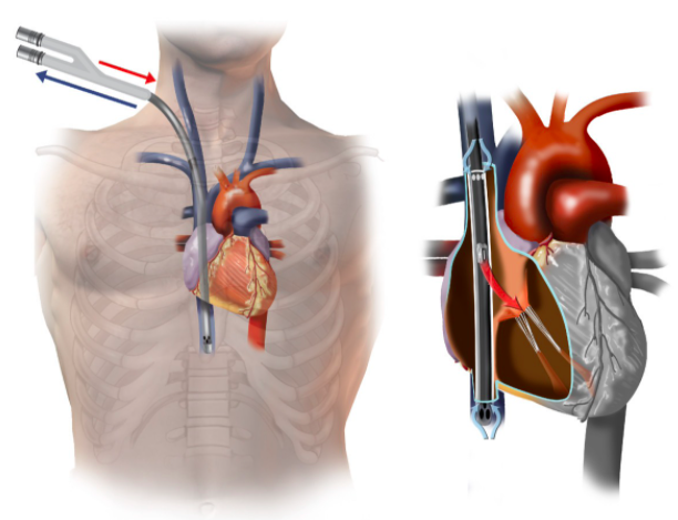 Dual Lumen Cannulation VV ECMO