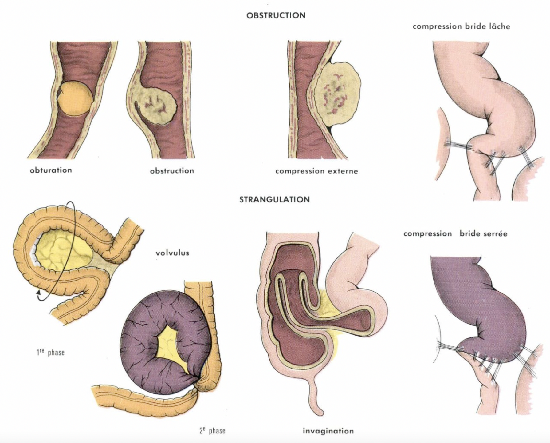 Image d'occlusions intestinales