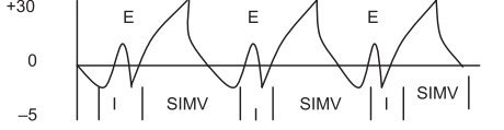 Ventilación mandatoria
intermitente sincronizada
(SIMV)