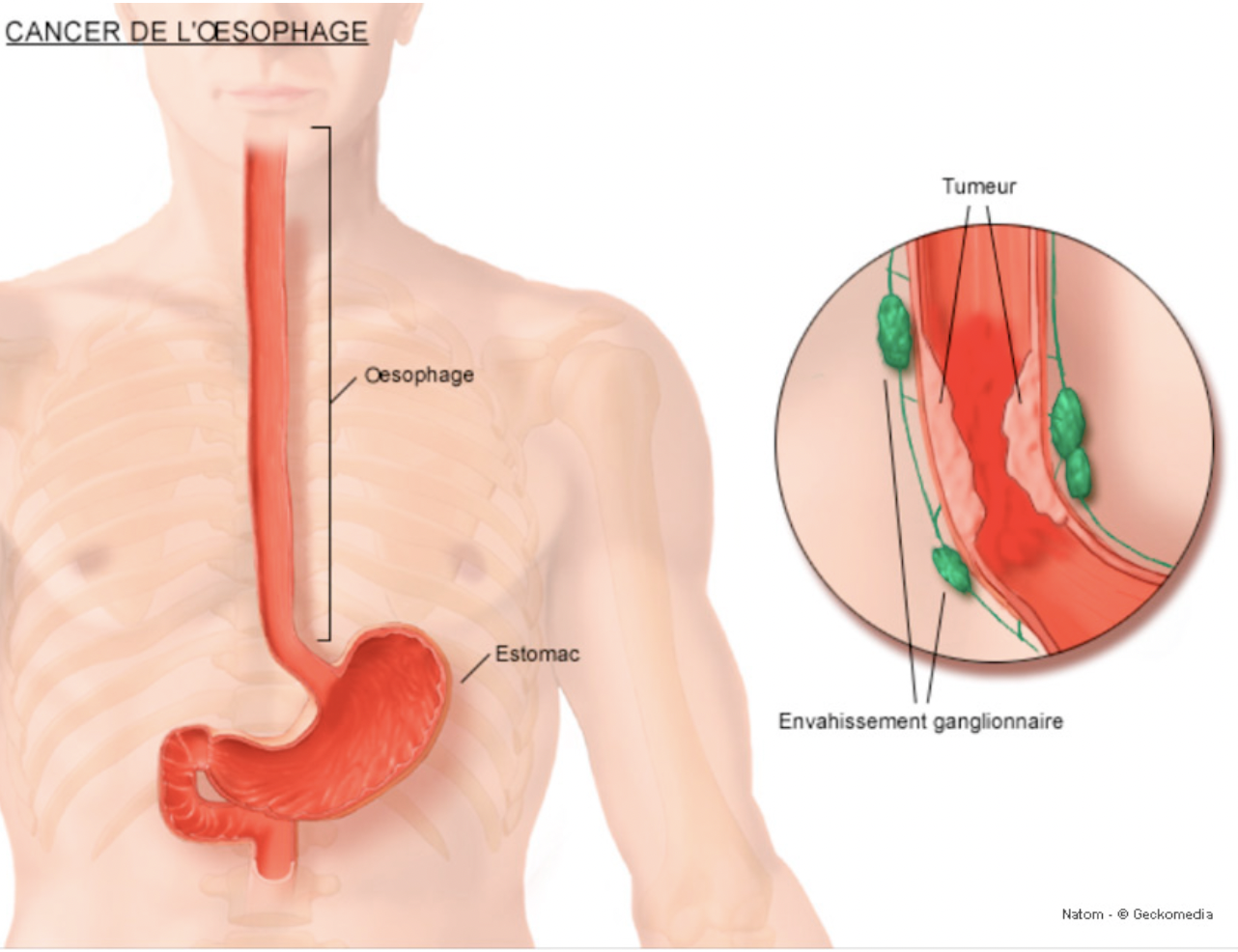 Cancer de l'oesophage:
Second cancer de l’appareil digestif après le cancer
colique.
C’est un cancer de l’homme de 50 à 70 an