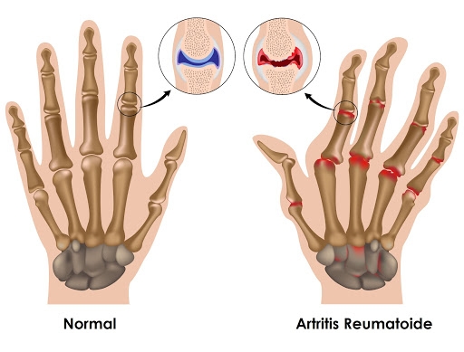 Artritis reumatoide