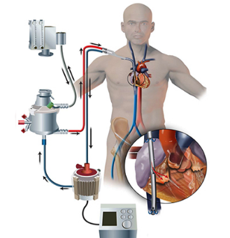 Extracorporeal Membrane Oxygenation
(ECMO)
by Jared Bienstock, MS, CCP, LP, CES-A
Copyright © 2021  (All Rights Reserved)