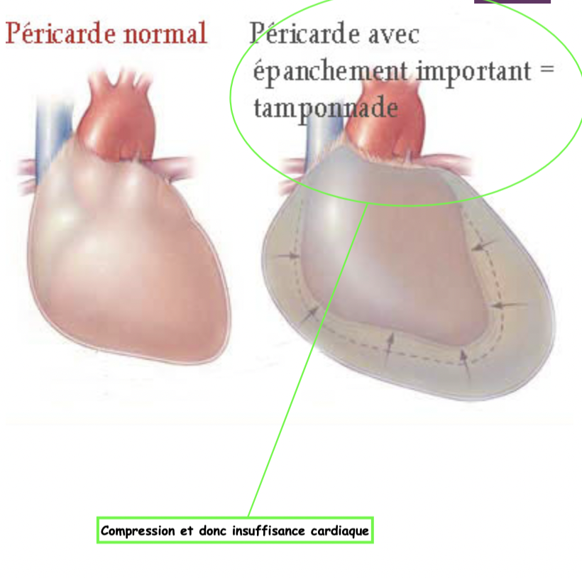 Primaire:
En présence d’un épanchement, le liquide sécrété à l’intérieur du sac péricardique comprime le cœur. Ce liquide pat