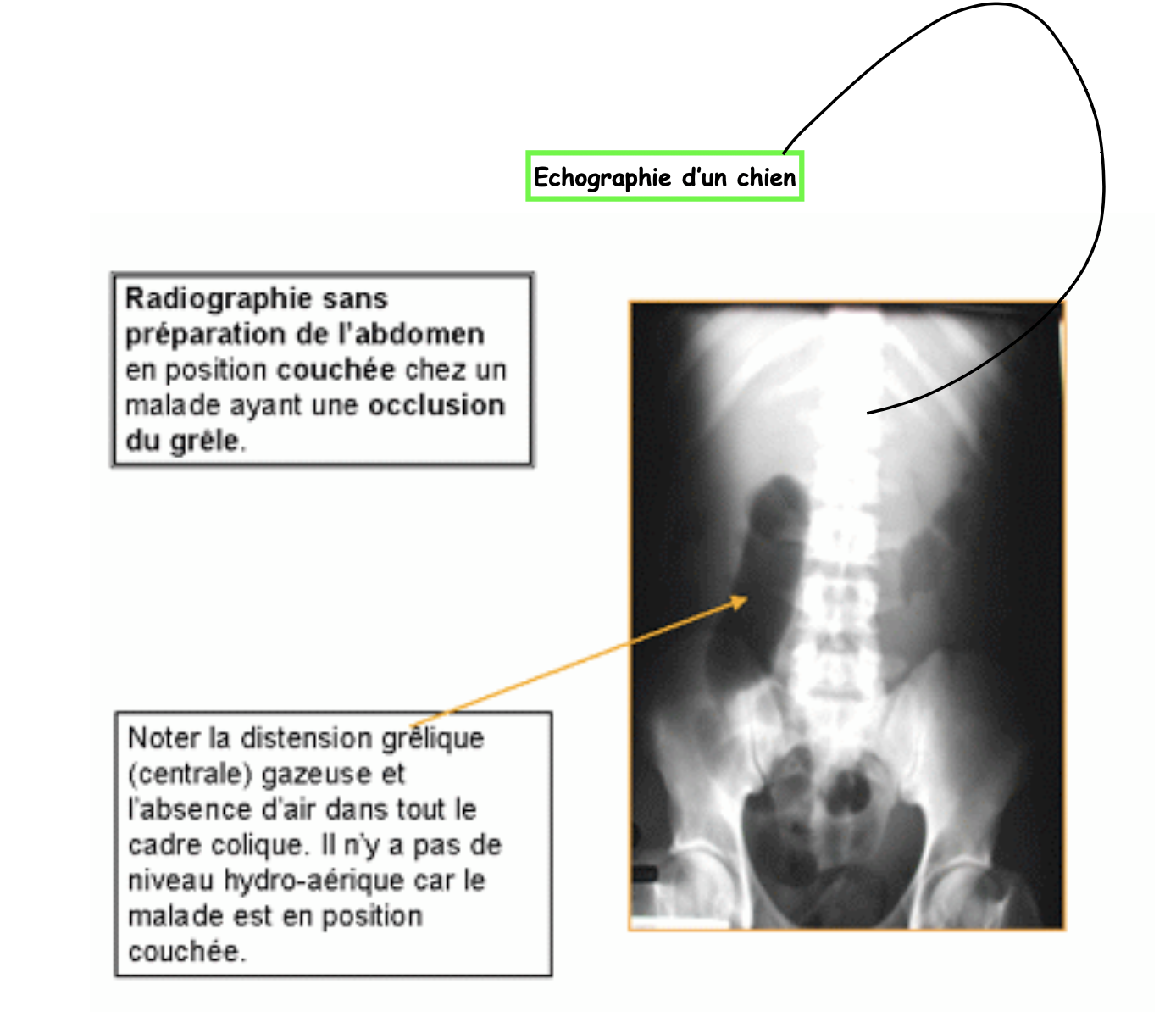 Occlusions intestinales:
Les Urgences chirurgicales
Une occlusion intestinale est un arrêt complet et permanent du transit da