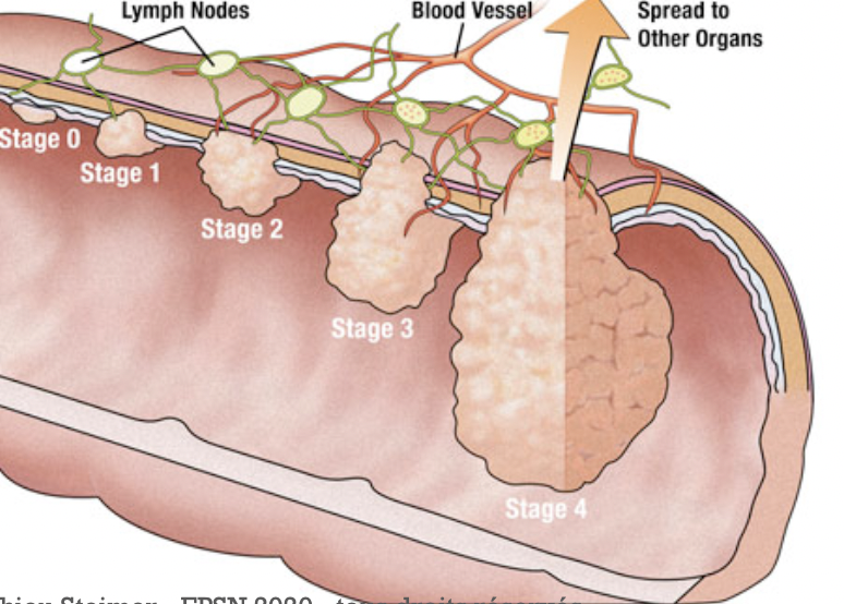 Cancer du colon:
Le cancer du côlon: le cancer en augmentation
depuis des années...
Comme énoncé précédemment, tout saignemen