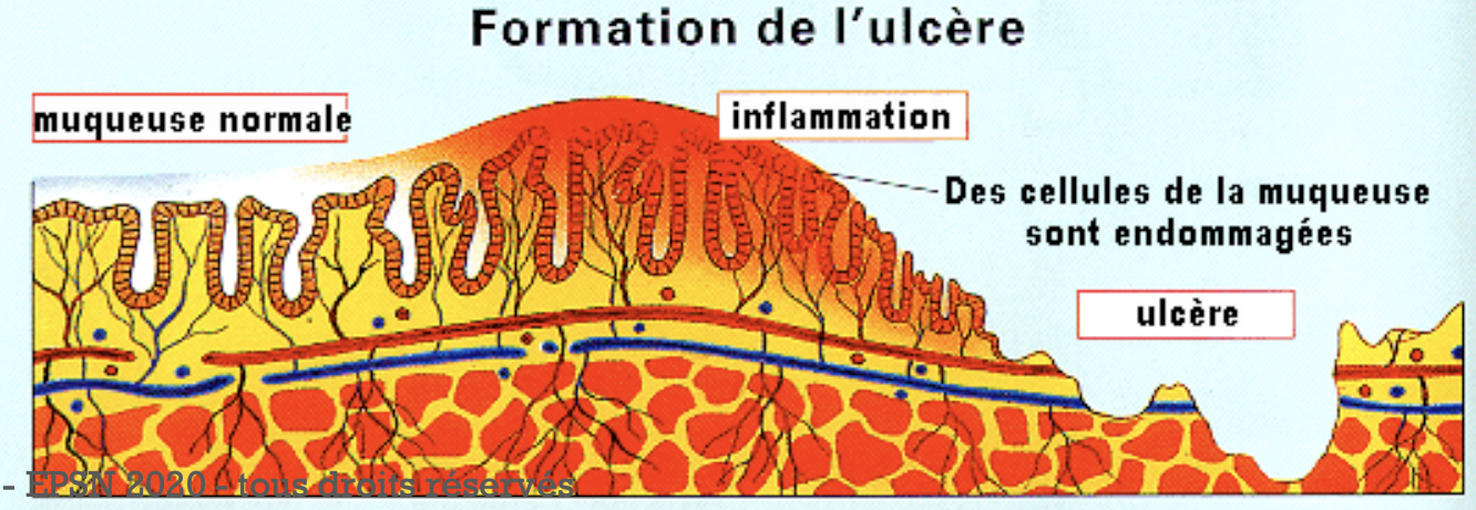 Ulcères gastroduodénaux:
C’est une pathologie qui se voit à tous les âges,
plutôt chez les hommes vers la cinquantaine.
- Mal