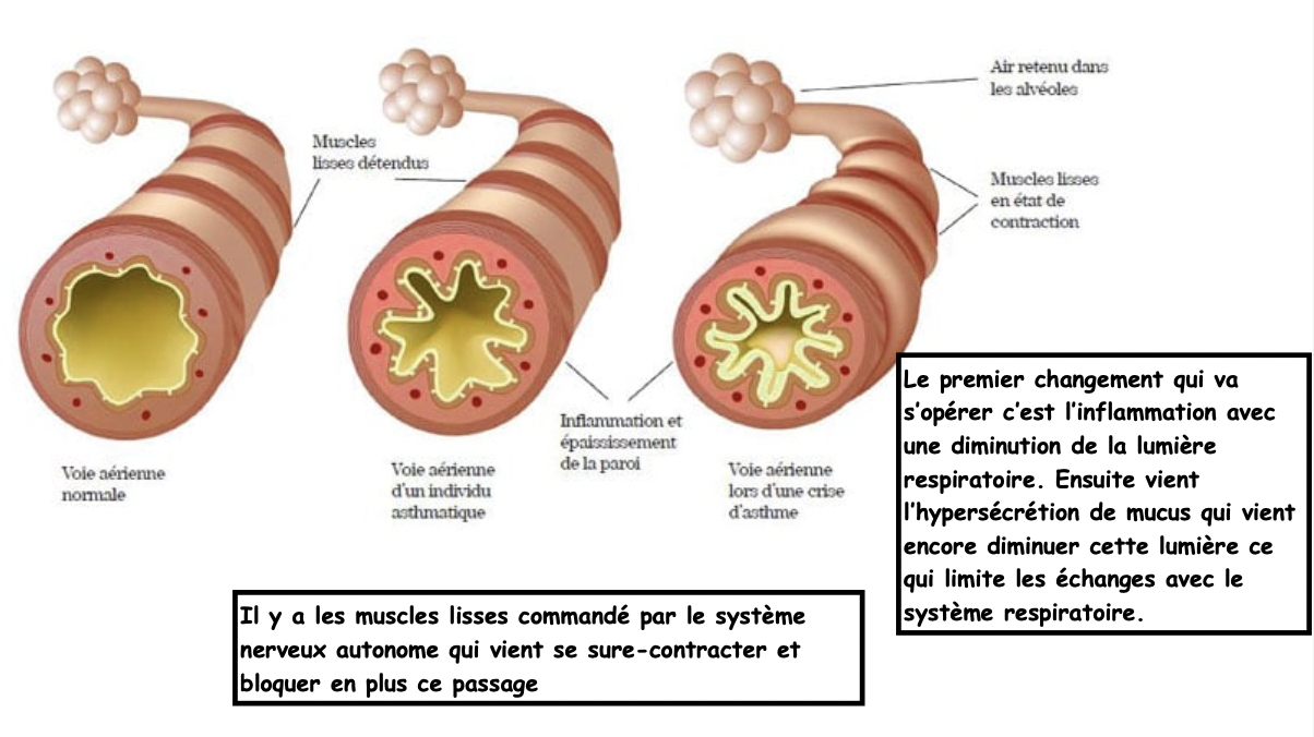 Asthme (systématiquement chronique)

L'asthme, ou maladie réactionnelle des voies respiratoires, est une affection chronique 