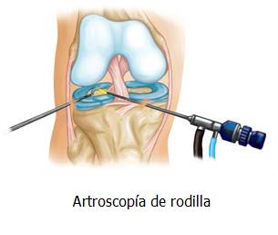 INUTILIDAD DE LA ARTROSCOPIA DE RODILLA