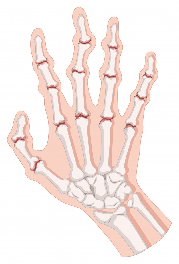 Artritis reumatoide