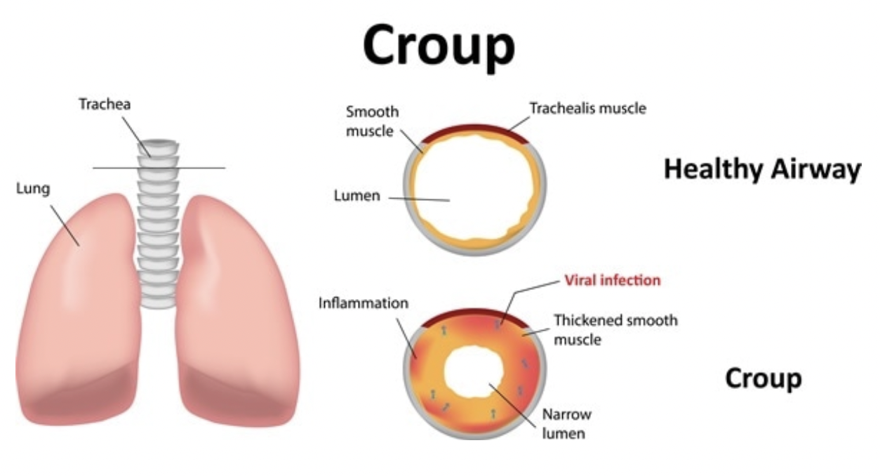 Physiopathologie / clinique:
Le croup provoque une enflure au niveau du larynx et de la gorge du petit malade. Celui-ci est a