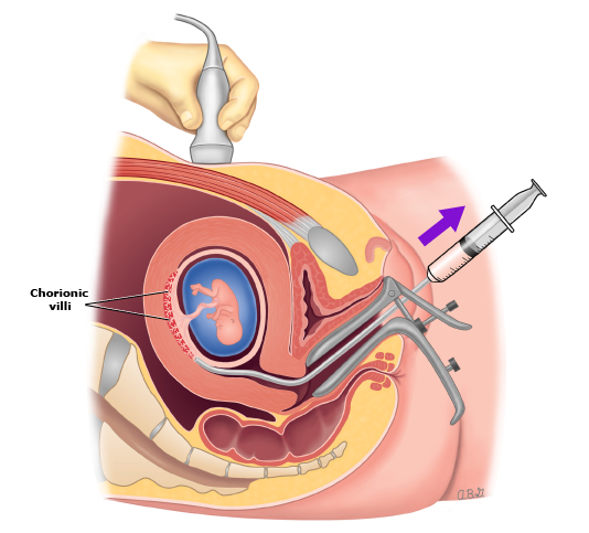 Chorionic Villus Sampling (CVS)