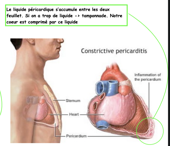 Les péricardites aiguës:
Une péricardite est une inflammation des feuillets du péricarde avec ou sans épanchement. La plus ty