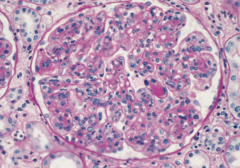 Puede haber glomerulonefritis