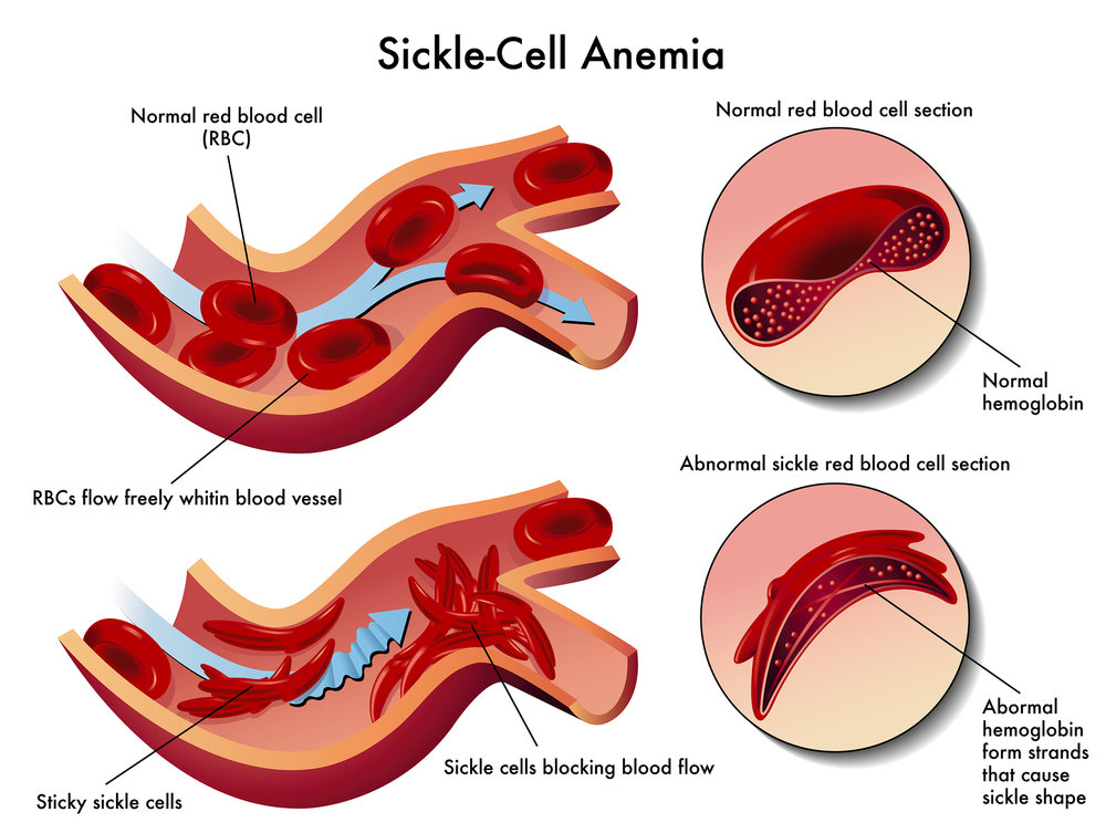 This image demonstrates the difference between Normal and Sickle Hemoglobin Cells and how the blood cells are different after