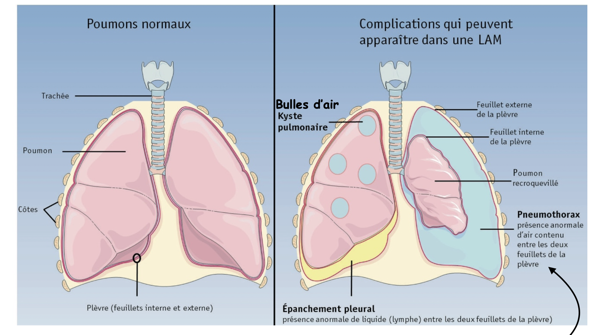 Symptômes:
Difficulté à respirer lors des efforts (dyspnée d'effort:
La dyspnée d’effort correspond à la difficulté à respire