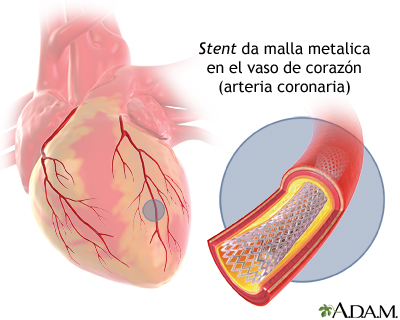 INUTILIDAD DE LOS STENT EN LA ANGINA ESTABLE                                                                                 