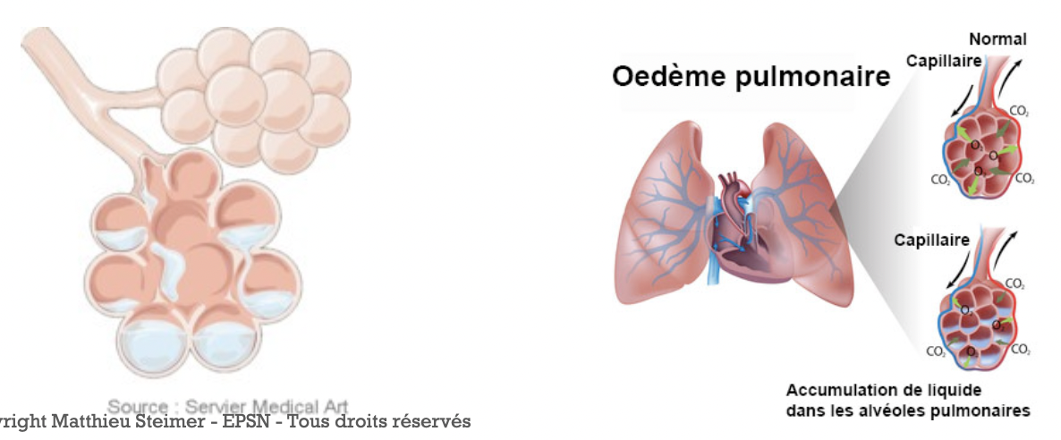 Insuffisance ventriculaire gauche:
L’insuffisance ventriculaire gauche aigue réalise le tableau de l’œdème aigu du poumon (OA