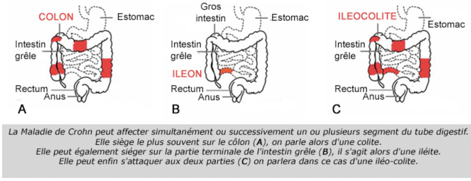 Maladie de Crohn:
Maladie auto-immune identique à la rectocolite
hémorragique.
Trouble inflammatoire généralement de la parti